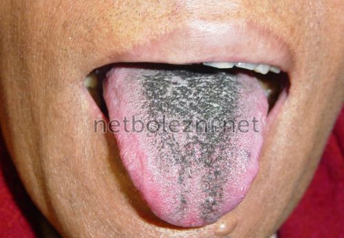 Черный налет на языке — начало больших проблем