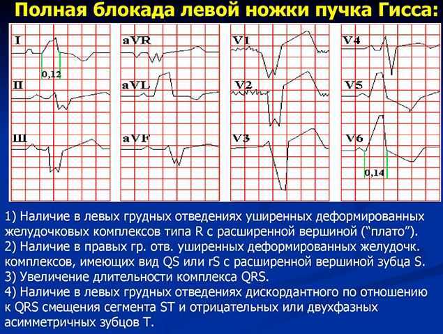 Блокада левой ножки пучка Гиса на ЭКГ (полная и неполная)