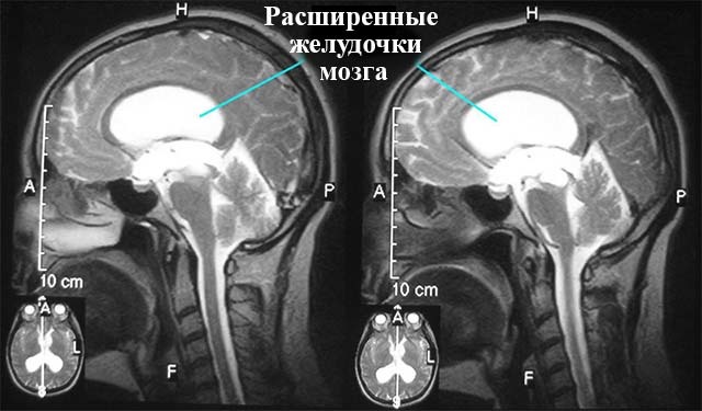 Расширение желудочков головного мозга у новорожденных