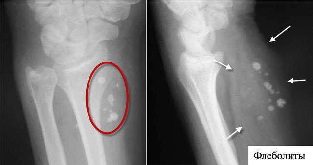 Флеболиты в малом тазу у мужчин - Все про холестерин
