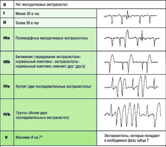Бигеминия: причины, виды, ЭКГ, лечение