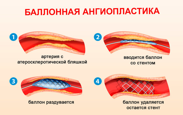 Операция после инфаркта миокарда