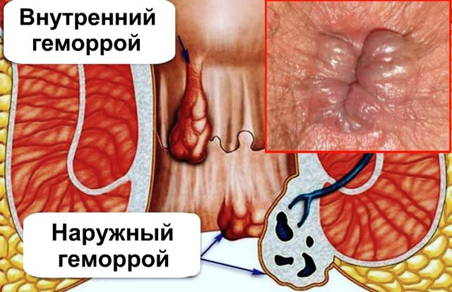 Гепариновая мазь при геморрое: как применять во время беременности