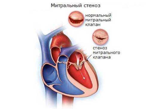 Аускультация сердца (выслушивание): точки, алгоритм, суть