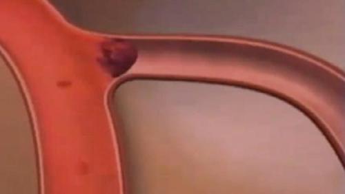 Инсульт спинного мозга (спинальный): симптомы, лечение, последствия