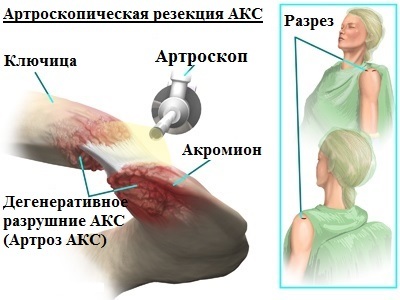 Боль в ключице, болит правая или левая ключица