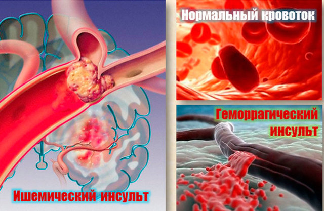 Предпосылки инсульта головного мозга у женщин - как избежать инсульта у женщин