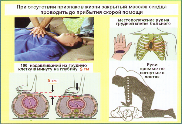 Что такое Непрямой массаж сердца?