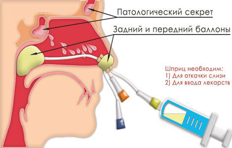 Хронический гайморит - симптомы и лечение без прокола у взрослых