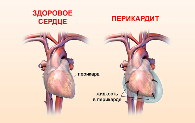 Как отличить сердечную боль от остеохондроза