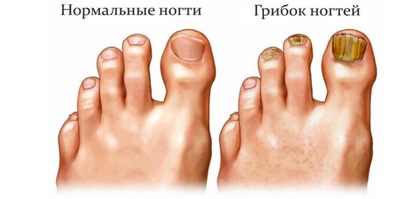 Чем лечится в домашних условиях грибок ногтей на ногах и руках