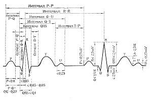 Регулярный и нерегулярный синусовый ритм сердца