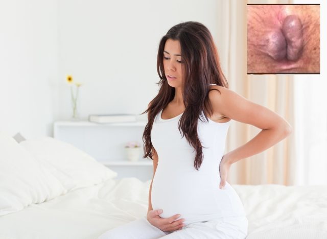 Индометацин свечи при геморрое - инструкция и отзывы