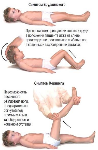 Менингит – симптомы и лечение у детей по видам заболевания