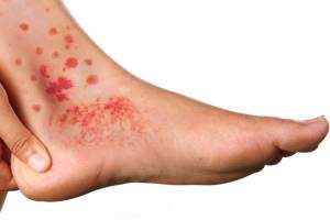 Васкулит мозга