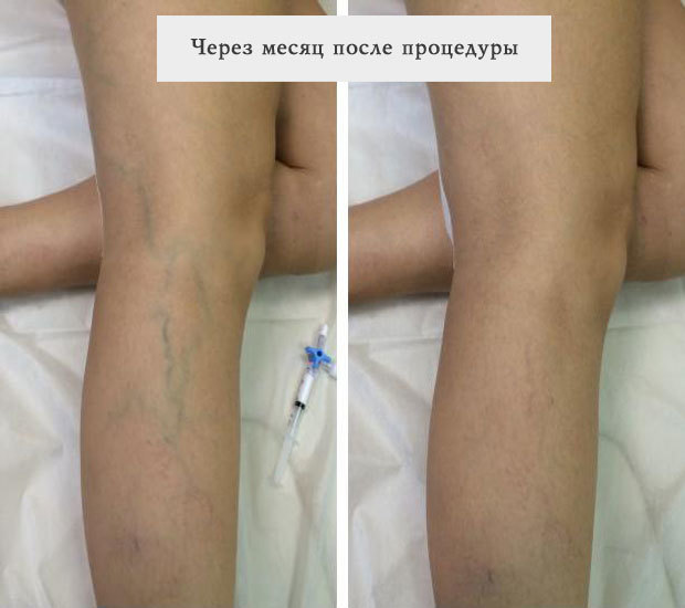 Склеротерапия вен нижних конечностей: плюсы и минусы