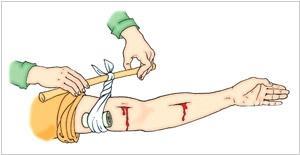 Виды кровотечений и оказание первой помощи