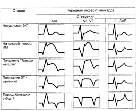 Инфаркт миокарда на ЭКГ: признаки, расшифровка