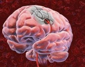 Ишемический инсульт головного мозга: прогноз для жизни. Реабилитация после инсульта