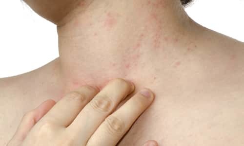 Вольтарен - 35 отзывов, инструкция по применению