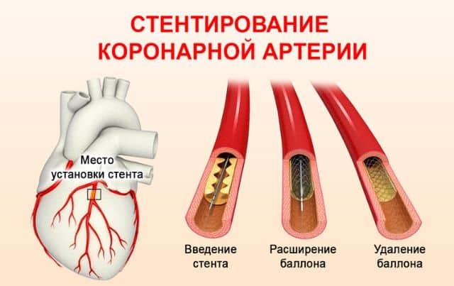Операция после инфаркта миокарда