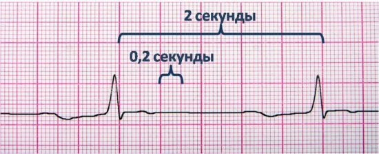 Синдром wpw на ЭКГ: что это? Рекомендации кардиолога
