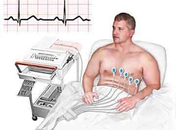 Блокада левой ножки пучка гиса на экг — Сердце