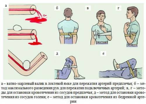 Первая помощь при артериальном кровотечении: алгоритм действий