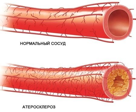 Нарушение липидного обмена: лечение народными средствами
