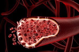 Васкулит мозга