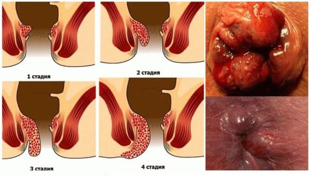 Как вылечить геморрой навсегда? Геморрой: отзывы, лечение, стоимость операции