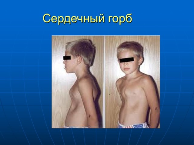 Сердечный горб что это такое - Лечение гипертонии