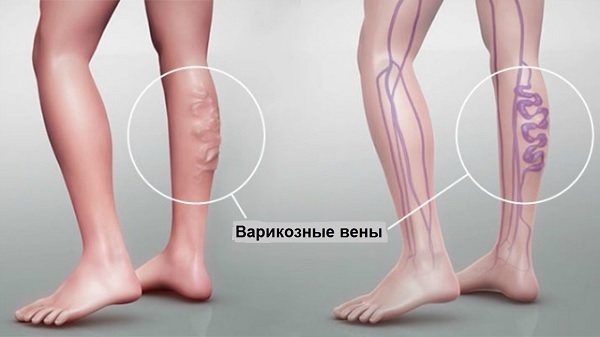 Симптомы варикозного расширения вен на ногах, степени и стадии варикоза