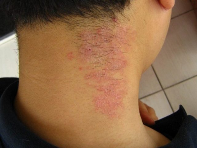 Уфок при аллергии — Все про аллергию