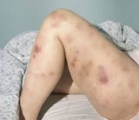 Особенности протекания и лечения миелоидного лейкоза