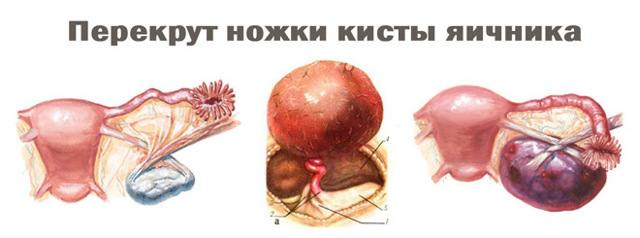 Фолликулярная киста яичника - симптомы, лечение, причины