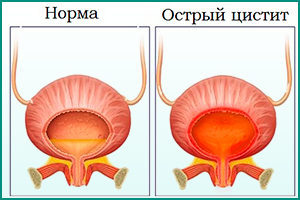 Острый цистит у женщин: симптомы и лечение
