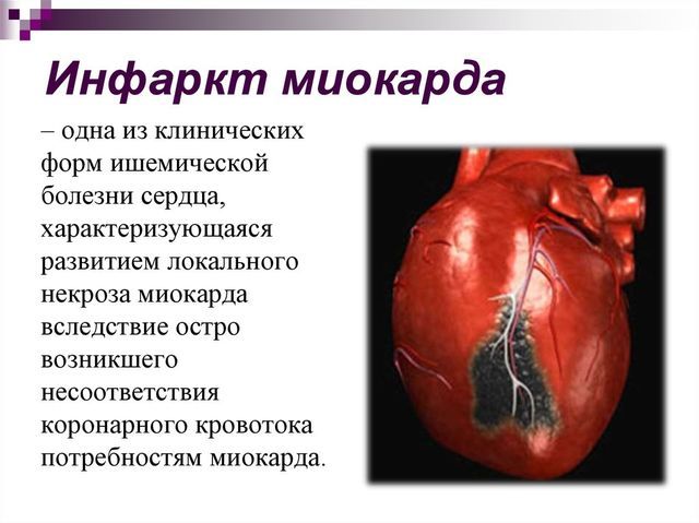 Как жить после инфаркта миокарда