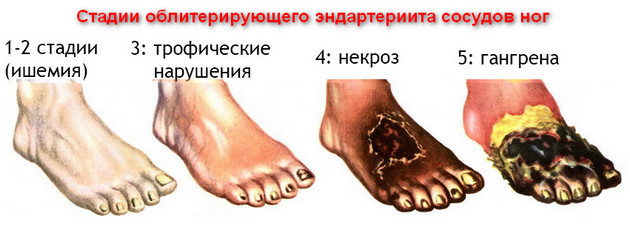 Что такое эндартериит - симптомы и лечение