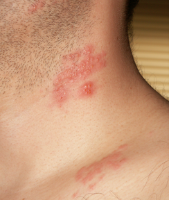 Красные пятна на теле у взрослого - появились красные пятнышки на лице