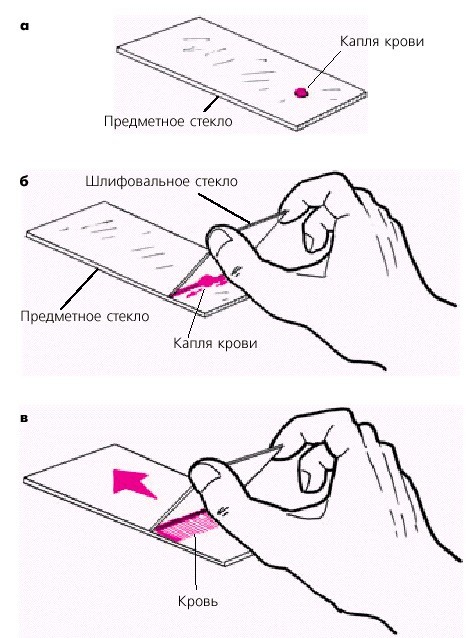 Средний объем тромбоцитов повышен - Гид-медик