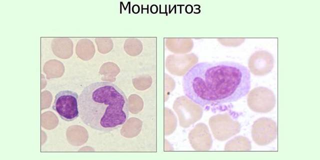 Моноциты повышены: допустимые нормы и причины превышений