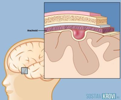 Киста сосудистого сплетения головного мозга: возникновение, диагностика, лечение. Опасна ли киста сосудистого сплетения для новорожденного?