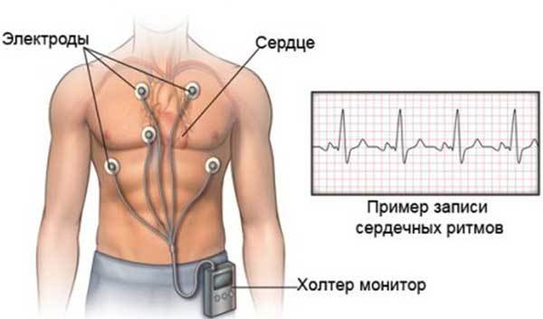 Cуточный мониторинг ЭКГ по методу Холтера - Лечим сердце