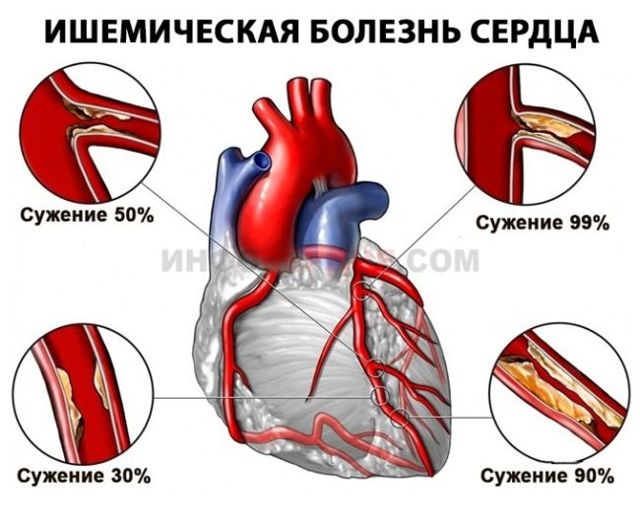 Сердце работает с перебоями замирает чем лечить — Сердце