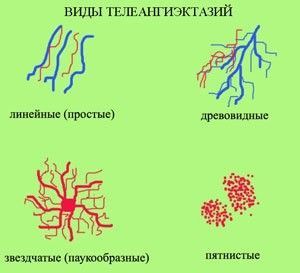 Сосудистые звездочки - почему появляются, вероятные причины, как избавиться