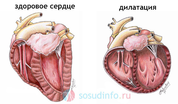 Дилатация камер сердца что это такое - Все про гипертонию