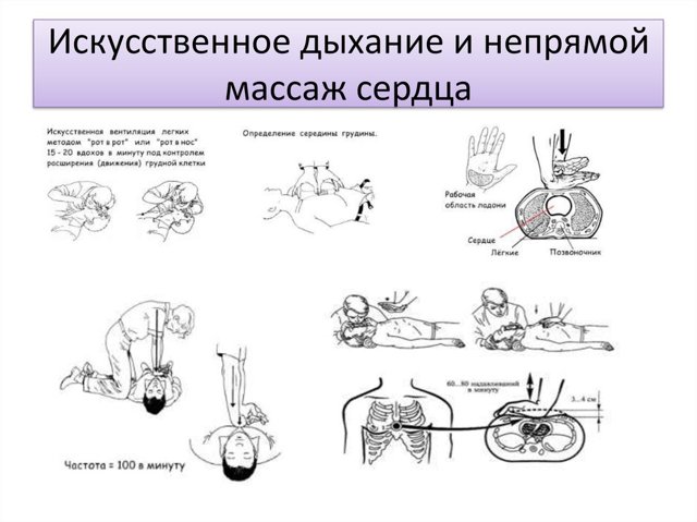 Что такое Непрямой массаж сердца?