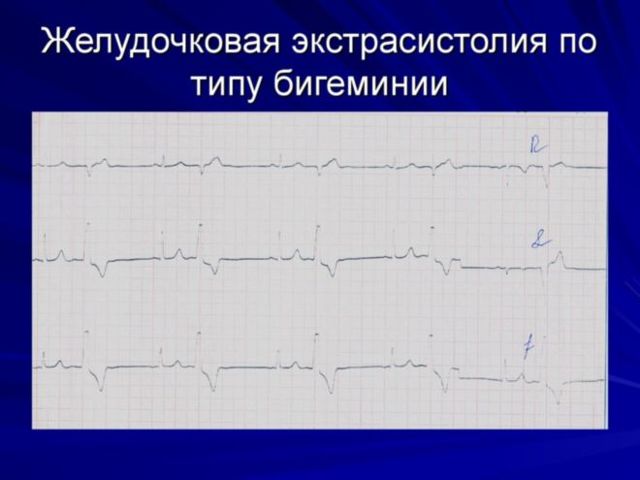 Экстрасистолы по типу бигеминии