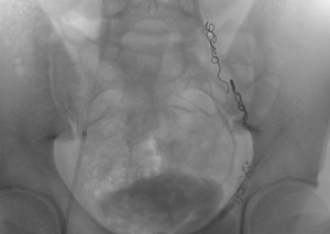 Видео операции варикоцеле яичка: процесс и исход